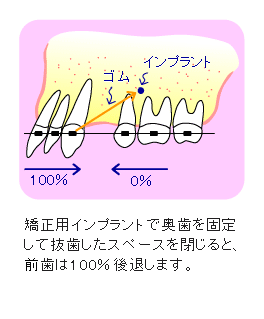 インプラント矯正 出っ歯の状態の方の前歯を後退させる場合2