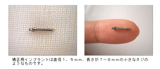 矯正用インプラント