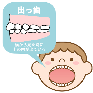 プレオルソ T4k マウスピース 子供の矯正1期治療 大阪矯正歯科グループ