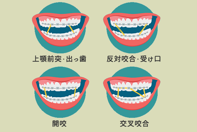 ゴムかけ